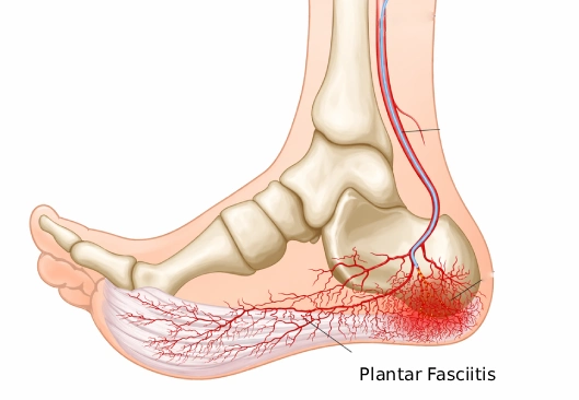 Plantar Fasciitis Embolization in Kandivali