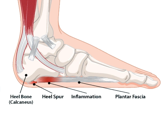 Plantar Fasciitis Embolization in Malad