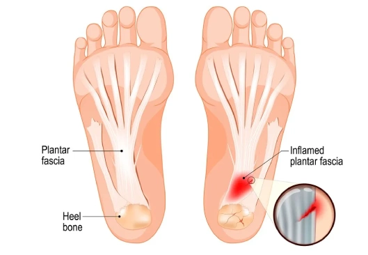 Plantar Fasciitis Embolization in Santacruz