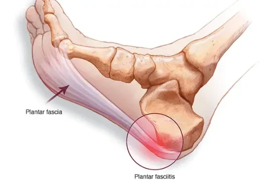 plantar Fasciitis Embolization in Borivali