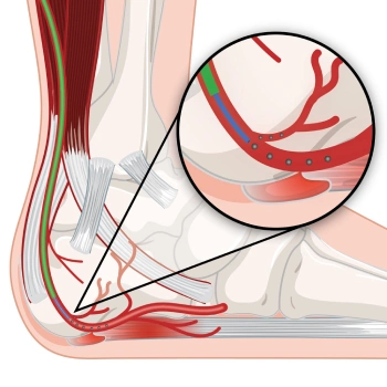 plantar fasciitis embolization in mira road