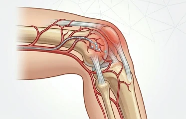 Genicular Artery Embolisation
